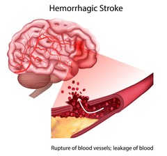 <p>Rupture of a cerebral blood vessel leading to bleeding in or around brain tissue.</p>