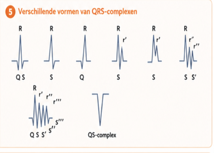 <ul><li><p>kleine letter = als bepaalde uitlsagen heel klein zijn tov gehele QRS</p></li><li><p>QRS volledig neg = QS complex → infarct bv (minstens in 2 afl te zien) </p></li><li><p>R = uitsluitend positief</p></li><li><p>RsR = positief met klein - deukje</p></li><li><p>RSR = + complex waarbij - deel onder iso elek lijn uitkomt</p></li></ul><p></p>