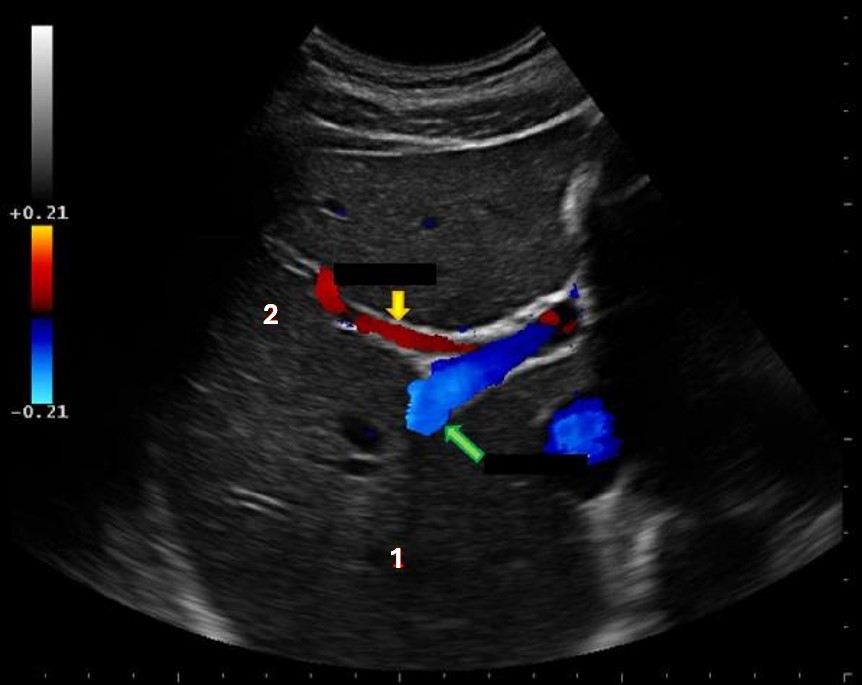 <p>what liver vessels indicated by the yellow arrow?</p>