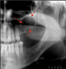 <p>How is this lesion described in terms of density?</p>