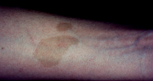 <ul><li><p>cafe-au-lait spots</p><ul><li><p>light brown (color of coffee with milk) macules with smooth (coast of California) borders</p></li><li><p>usually 6 or more greater than 1.5 cm</p></li></ul></li><li><p>axillary freckling</p></li><li><p>lisch nodules (benign pigmented nodules of iris)</p></li><li><p>multiple neurofibromas </p></li></ul><p></p>