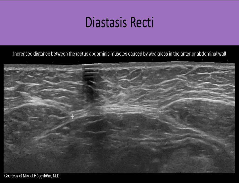 <p>C. distance between the rectus abdominis muscles</p><p>Diastasis Recti is diagnosed when there is an increased distance between the rectus abdominis muscles caused by weakness in the anterior abdominal wall.</p><p class="p1">The linea alba is normally a narrow fibrous band in the midline abdomen that separates the two rectus abdominis muscles. Muscle weakness and thinning/stretching of the linea alba cause diastasis recti. This abnormality is seen with pregnancy, obesity and in newborns. It can be differentiated from a ventral hernia because there is no fascial defect. It presents as a midline bulge that increases with increased abdominal pressure.</p>