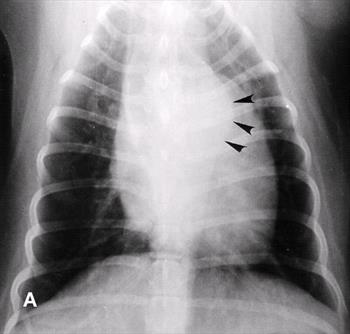 <p>Ductal bulge</p>