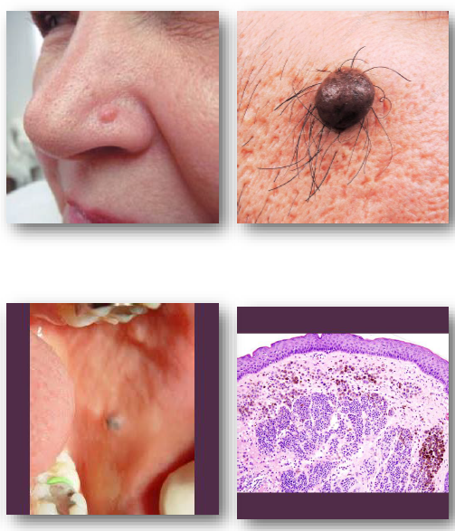 <ul><li><p>more into dermis than epidermis</p></li><li><p>limited pigment</p></li><li><p>fleshy appearance </p></li></ul><p></p>