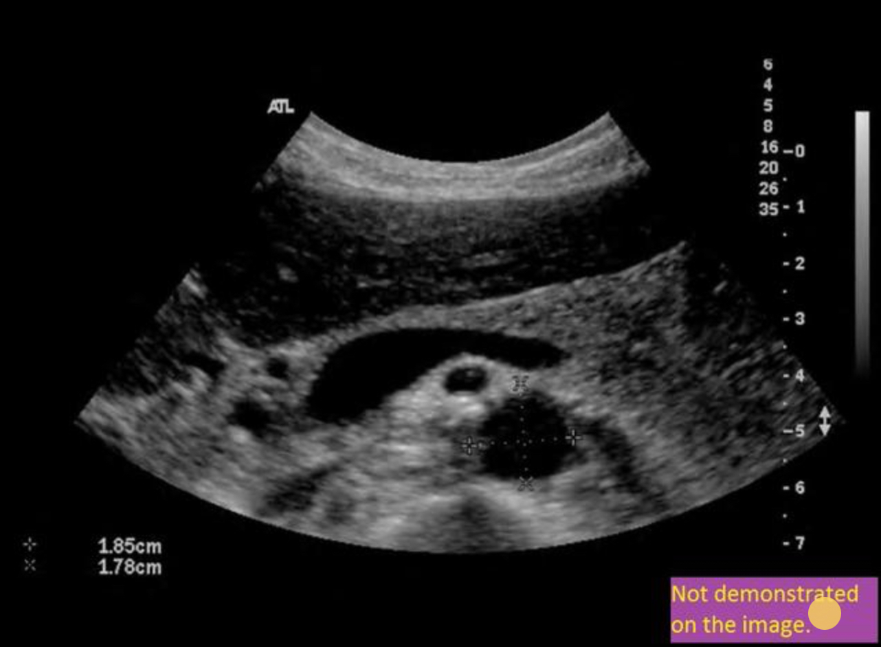 <p>Use your mouse to place your cursor over the superior mesenteric vein and click to mark the vessel if the vessel is not demonstrated on the image, mark the purple box that says “not demonstrated on the angle”.</p>