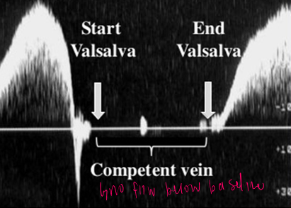<p>no flow while bearing down</p><p>return of flow upon exhaling </p>