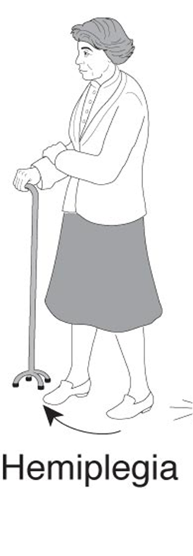 <p>hemiplegia </p>