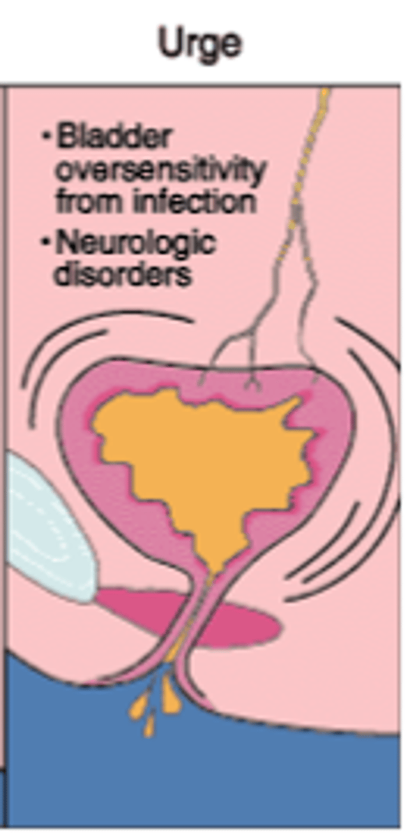 <p>age, neurologic disease</p><p>(this is when detrusor contracts even if bladder isnt full)</p>
