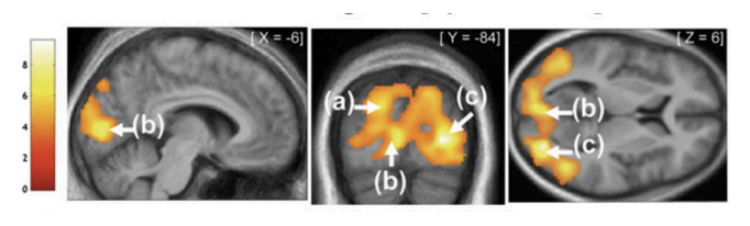 <ul><li><p>Audition &amp; blindness</p></li><li><p>Early blindness can produce remapping of auditory information in occipital lobe.</p></li><li><p>Cortex normally reserved for vision is recruited by auditory system to improve spatial resolution (vision is normally most spatially precise modality).</p></li></ul><p></p>