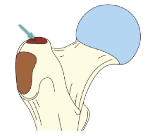 <p>FAUX : sur la face supérieure du grand trochanter</p>