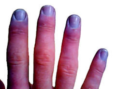 <p>a bluish or purplish tint to the skin, lips, tongue, or nail beds caused by a lack of oxygen in the blood</p>