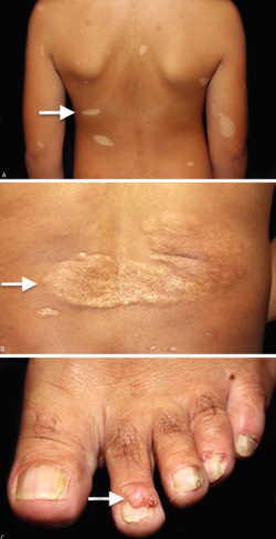 <p><u>hypopigmented spots:</u> tuberos sclerosis</p><p><u>hemangioma trigeminal nerve region:</u> sturge webber syndrome</p><p><u>petechia and hepatosplenomegaly: </u>CMV infx</p><p>facial dysmorphic features</p>