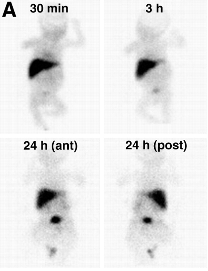 <p><span>The following scintigraphy image is indicative of:</span></p>