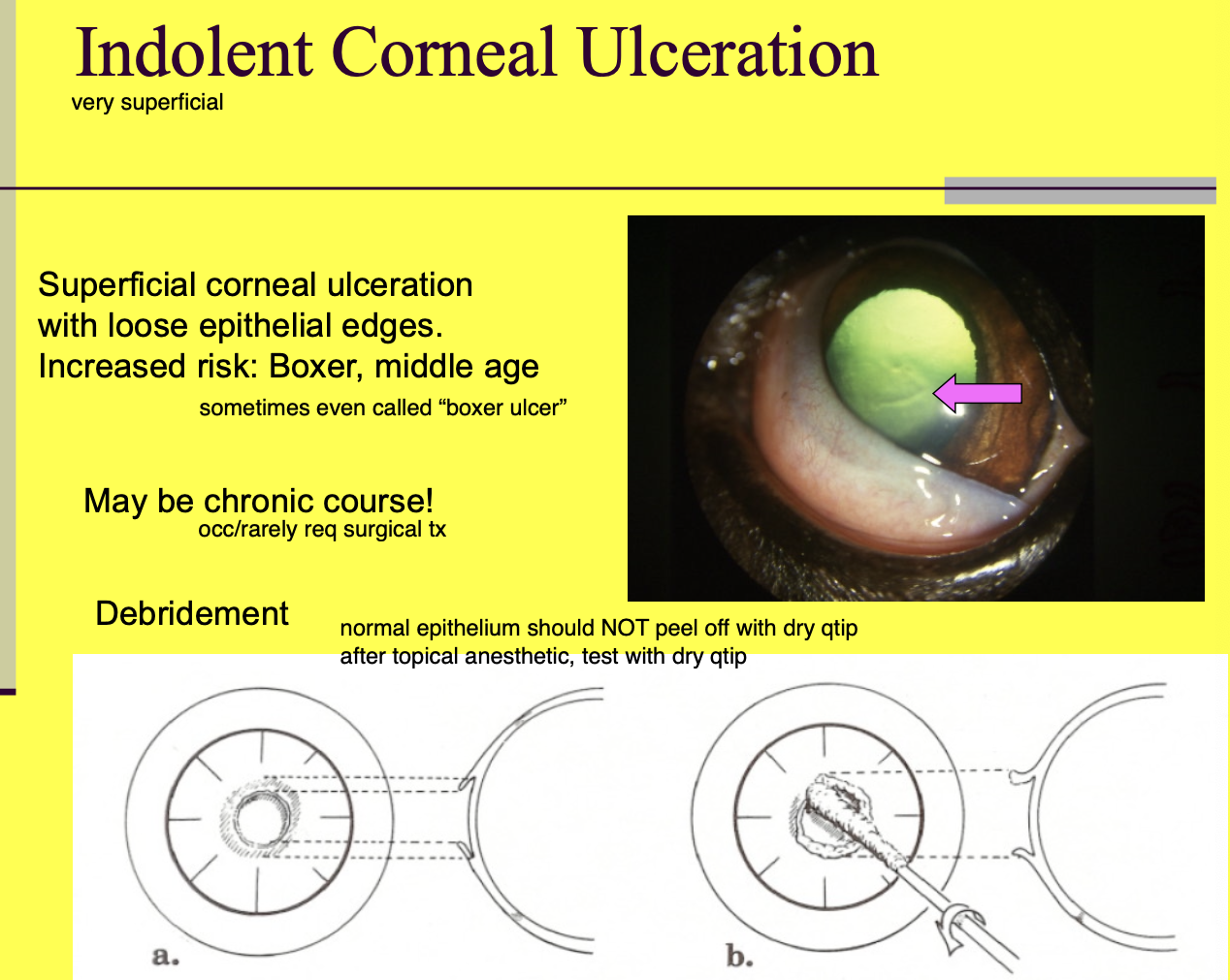 <p>superficial corneal ulceration w/ loose epithelial edges (epithelium does not want to stick back to stroma)</p>