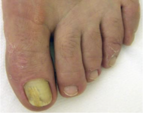 <p>Physical examOnychomycosis</p>