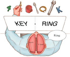 <p>a condition resulting from surgery that isolates the brain's two hemispheres by cutting the fibers (mainly those of the corpus callosum) connecting them.</p>