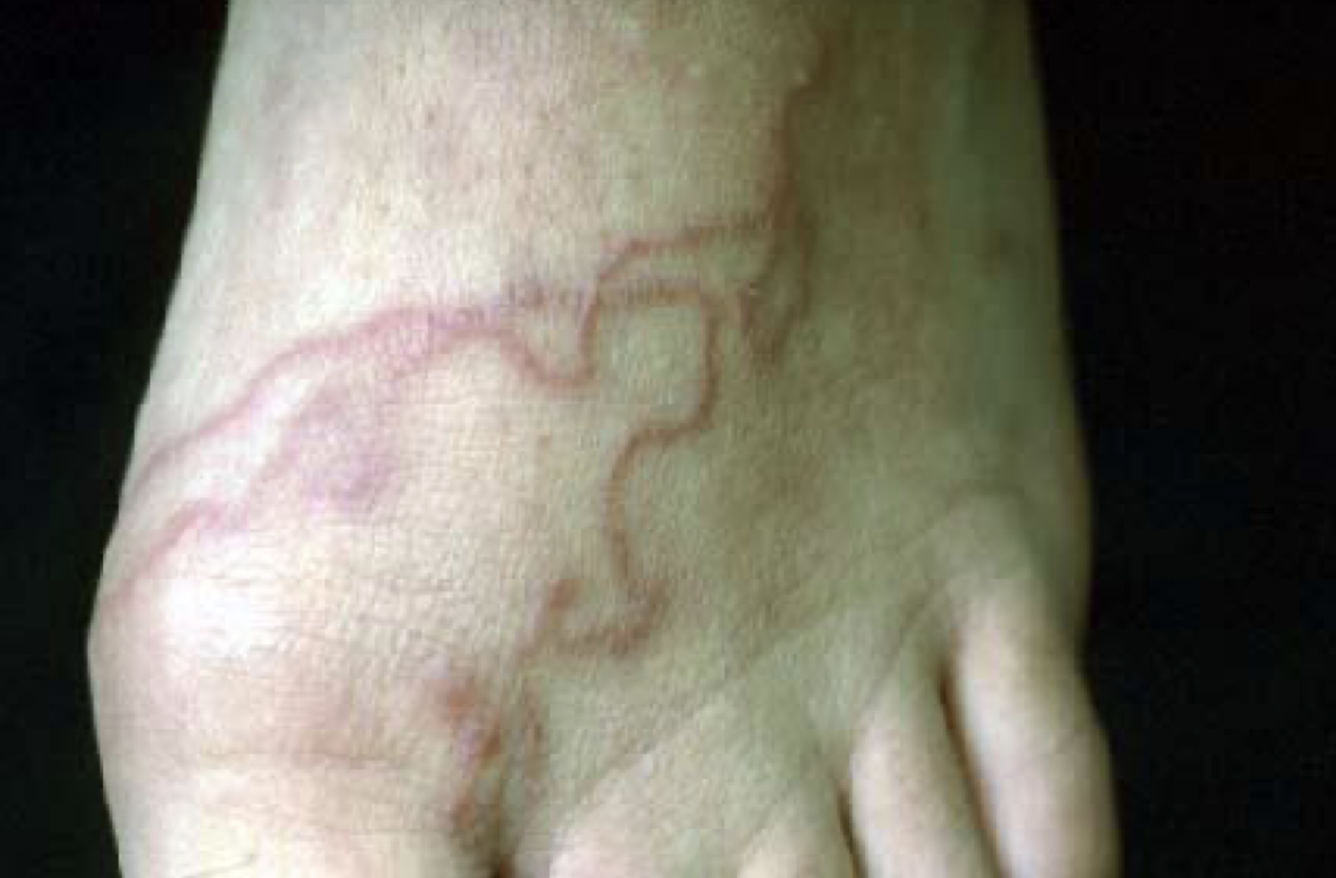 <p>What parasite causes this?</p>