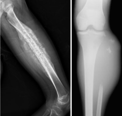 <p>What is this?</p><p>- 10-25 yo, White male</p><p>- Pain (Local + Swelling)</p><p>- Diaphyseal - Femur, Innominate, Tibia, Fibula, Humerus, L/S + Sacrum</p>
