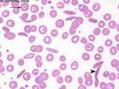<p>what would the RBC morphology look like in those with Hb SC disease? <strong>(learning objective)</strong></p>