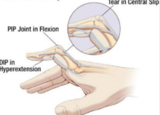 <ul><li><p>Bending of the proximal interphalangeal joint posteriorly, affected by the torn central slip extensor tendon</p></li><li><p>Rupture to the extensor tendon of the proximal interphalangeal joint</p></li><li><p>Distal joint will extend due to the pull of the tendon</p></li></ul><p></p>