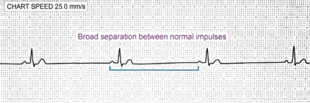 <p>Regular rhythm, normal P before every QRS, but rate <60 bpm</p>