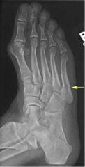 <p>fractured base of 5th metatarsal</p>