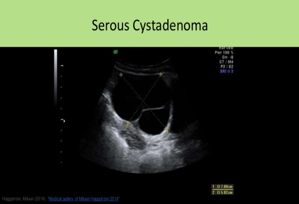 <p>A. serous cystadenoma</p><p>A large, anechoic, unilocular cyst in a postmenopausal woman is most likely a serous cystadenoma. Although serous cystadenoma are more prevalent in women 20-50, they can occur in postmenopausal women. A postmenopausal patient that is not taking hormones or other medications that might influence ovarian function will not have a functional cyst. Papillary cystadenoma will demonstrate papillary excrescences. Mucinous cystadenoma will demonstrate loculations and internal debris.</p>