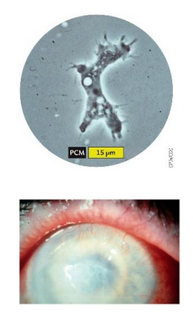 <p>Acanthameoba Ecnephalitis</p>