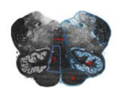 <p>What is B ?</p><p>A. Inferior olivary nucleus</p><p>B. Caudate nucleus</p><p>C. Gracile nucleus</p><p>D. Pyramid</p>