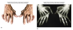 <p>autoimmune disease</p><p>attacks the synovial membrane</p><p>ossification of degenerated cartilage</p><p>ankylosis - bones become solidly fused - immobilization</p><p>no cure</p>