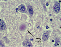 <p>fibrillar aggregates- lewy bodies (similar to inclusion formation in Huntington’s ) (by the time motor symptoms appear, approx 60% dopamine neurons are lost)</p>