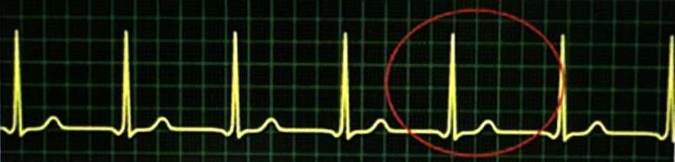 <p>Notice the inverted P wave</p>