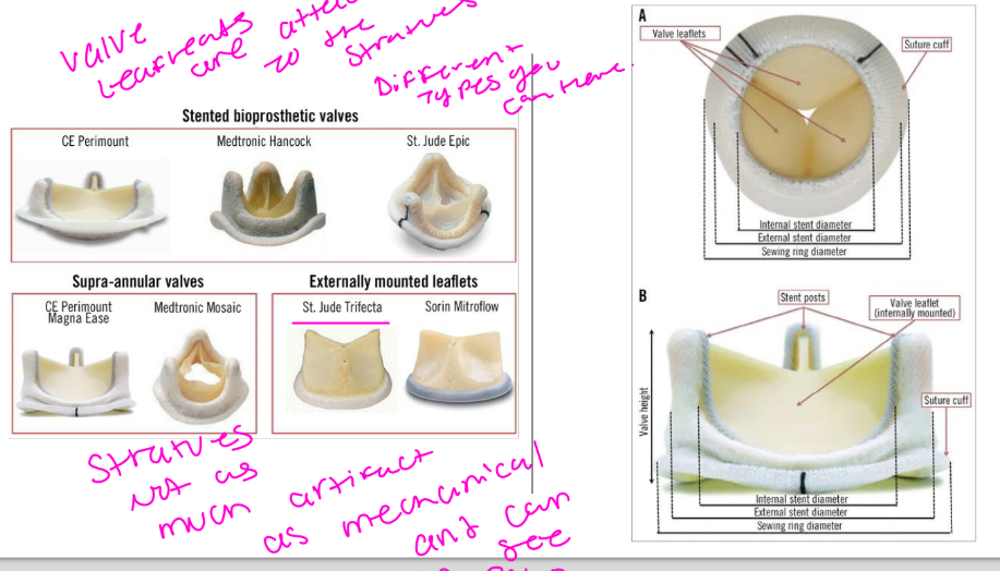 <p>Regurgitation is increasingly reported in normal biologic valves</p><p>• Stentless valves, including homografts and autografts, are more</p><p>likely than stented valves to have minor regurgitant jet</p>