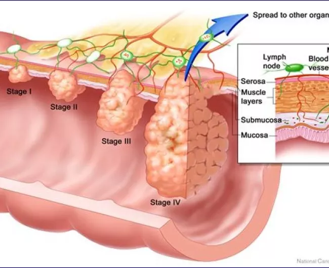 <p>Stage I (or A): Invasion into the<strong> submucosa</strong></p><p>Stage II (or B): Invasion into the<strong> serosa</strong></p><p>Stage III (or C): Invasion into the<strong> serosa w/ + nodes</strong></p><p>Stage IV (or D): Any invasion w/<strong> distant mets</strong></p>