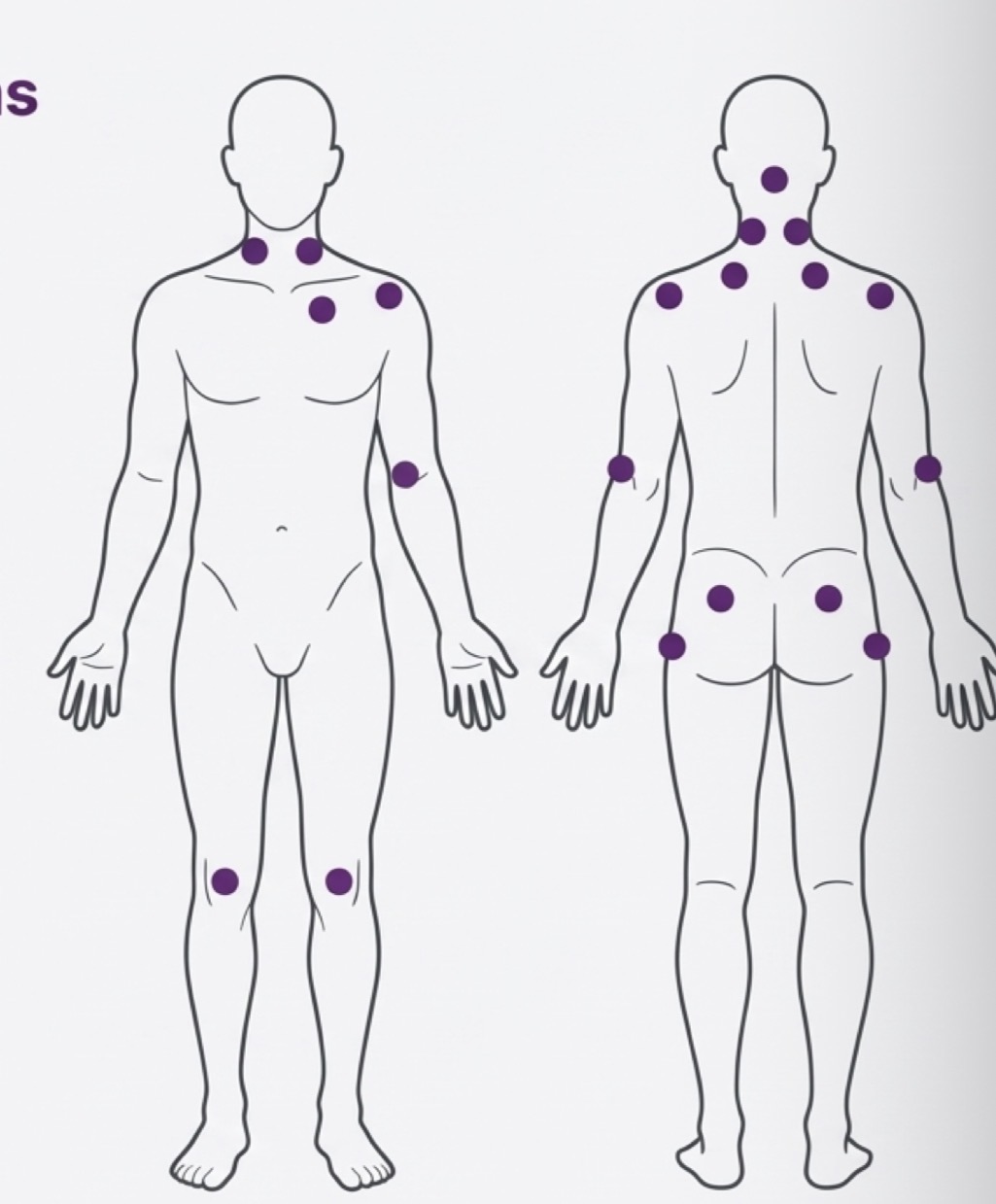 <p>Systemic chronic musculoskeletal pain disorder </p><p>Generalised pain, severe fatigue, poor sleep- diagnosed when tenderness in 11-18 specific points </p><p>Coexist with chronic masticatory muscle pain </p><p>Conservative and palliative care </p><p>Low dose tricyclic antidepressants (Amitriptyline 10-50mg) to improve sleep </p><p>Refer to rheumatologist </p>