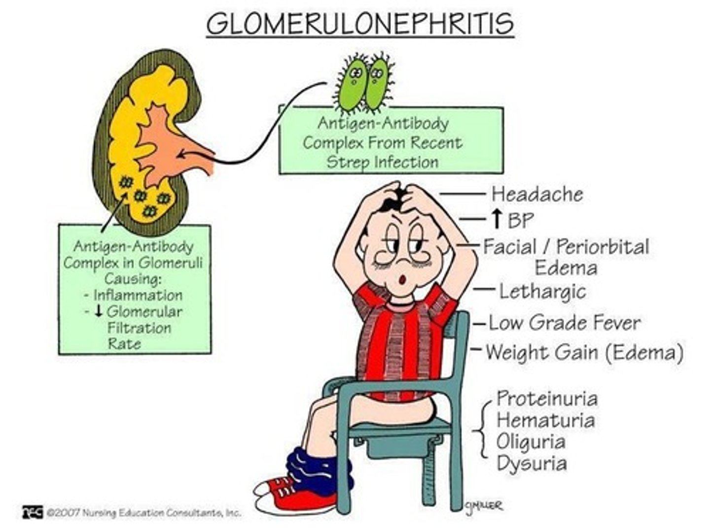 <p>• Inflammation of the glomerulus</p><p>- Caused by: streptococcus OR weird immune mechanism (type 3 hypersensitivity - antigen antibody complex, form a complex and this complex travels around the body and causes inflammation and one of the places is in the glomerulus, it punches holes in the glomerulus which causes proteins and blood to travel through which shouldn't)</p><p>• Sx: hypertension, due to RAAS., protein and blood loss</p>