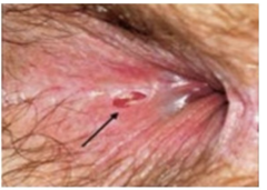 <p>The picture depicts an anal fissure, a painful tear in the lining of the anus: what nerve supply somatic sensory fibers to this</p>