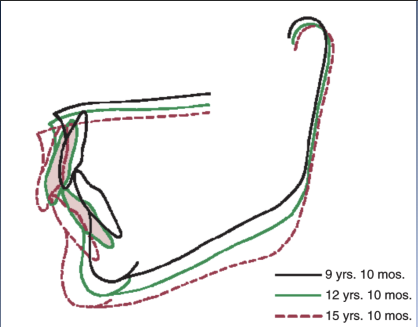 <p><span>Rotational patterns of growth are quite different for individuals with short/long face types</span><br><span>SHORT FACE</span><br><span>1. Excessive forward rotation of the mandible</span><br><span>1. Increase in the normal internal rotation</span><br><span>2. Decrease in external compensation</span><br><span>2. Nearly horizontal palatal plane angle</span><br><span>3. Low Mn plane angle</span><br><span>4. Large gonial angle</span><br><span>5. Deep bite and crowded incisors</span></p>