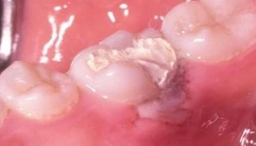 <p>chemical burn </p>
