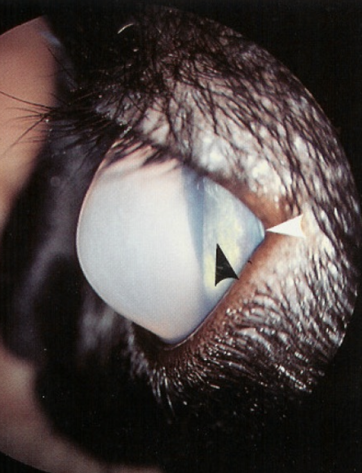 <p>Corneal edema can lead to </p>