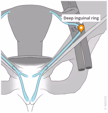 <ul><li><p>Midway between anterior iliac spine and pubic symphysis</p></li><li><p>Above inguinal ligament and lateral to inferior epigastric vessels</p></li></ul><p></p>
