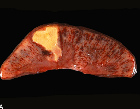 <ul><li><p>audinys <strong>tvritas, kietas, sausas, pilkai gelsvas</strong></p></li><li><p><strong>aiški riba tarp pažeisto ir sveiko audinio</strong></p></li><li><p>infarktas būna pleišto formos ir geltonas</p></li></ul><p></p>