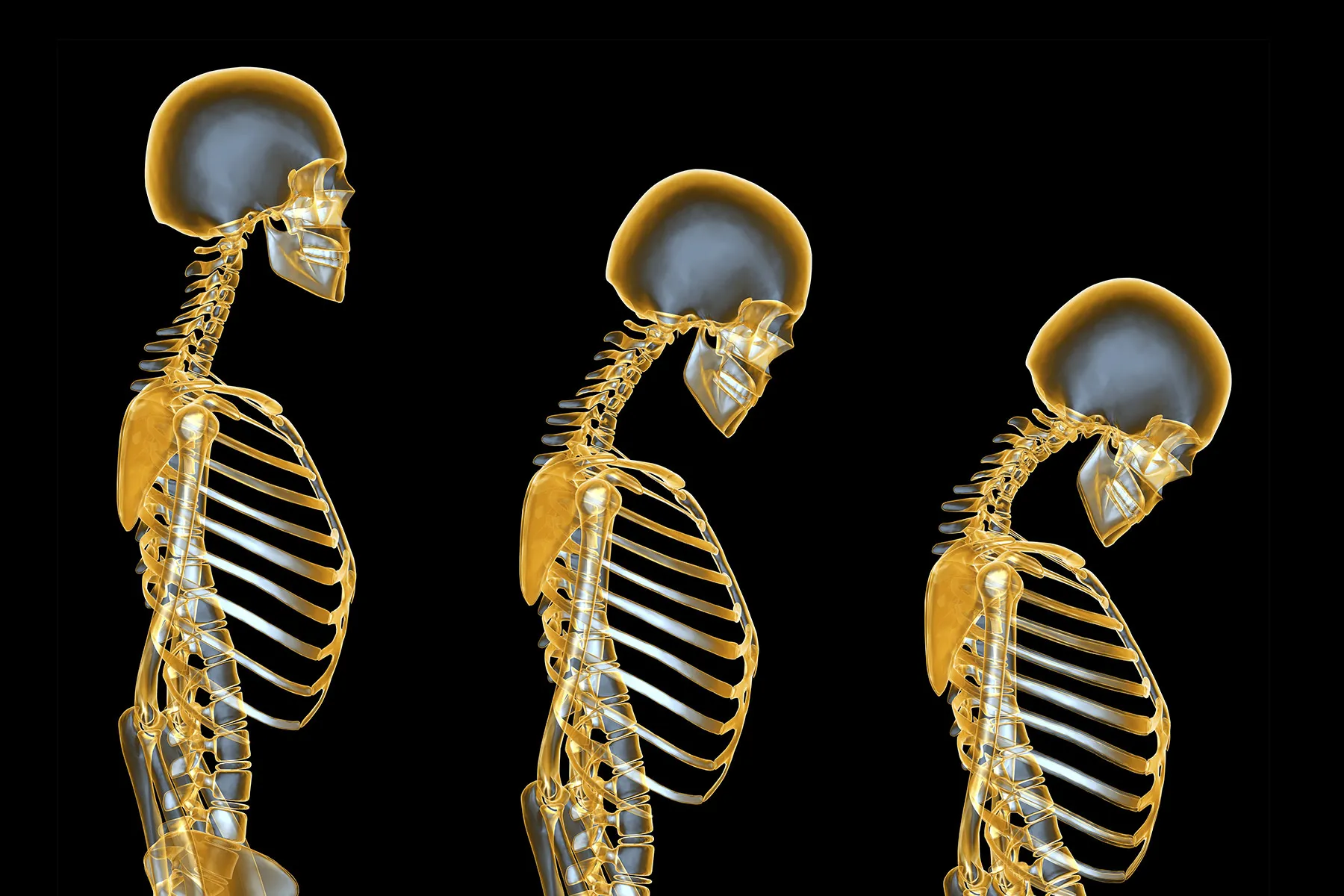 <p>A condition in which bone reabsorption occurs faster than bone formation, resulting in porous, light, and fragile bones.</p>