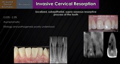 <p>Invasive Cervical Resorption</p><p>-starts at cervical level</p>