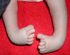 <p>A birth defect in which one or both feet are interiorly rotated. Often isolated. May be related to spina bifida, myotonic dystrophy, Potter's sequence, or fetal positioning.</p>