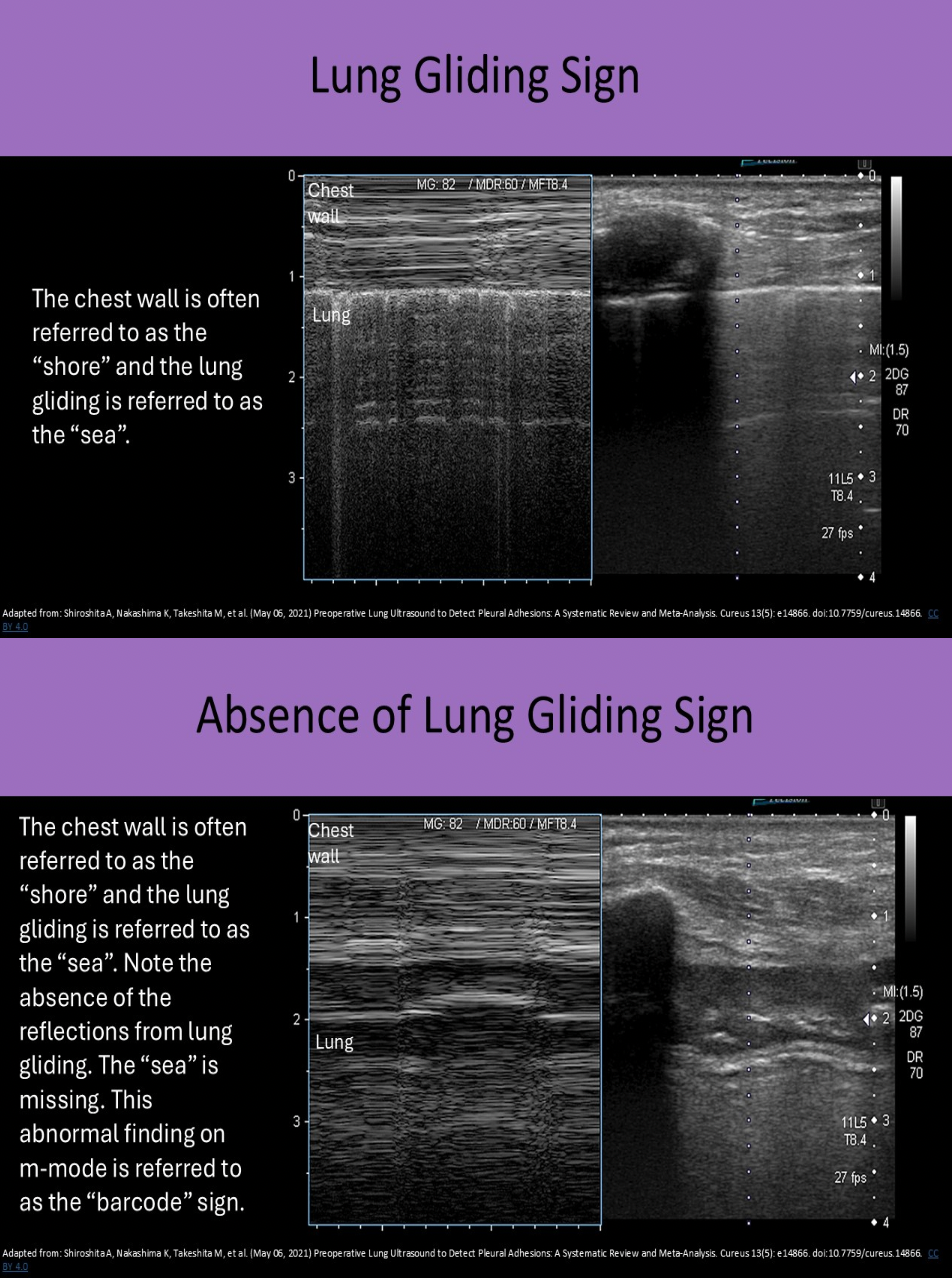 <p>B. the lung-gliding sign is not present with free air in the chest</p><p class="p1">Ultrasound can be used to evaluate lung motion and the presence of certain artifacts can indicate lung disease. Lung-gliding sign - visceral pleura and underlying aerated lung can be seen gliding across the parietal pleura in the normal lung.</p><p class="p1">Pneumothorax: Ultrasound most helpful in evaluating patients that cannot sit upright for a chest x-ray. Free air in the chest can be a complication caused by thoracentesis. The free air can be seen between the visceral and parietal pleura and the lung-gliding sign is lost.</p>