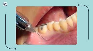 <p>What landmarks are anesthetized with an incisive block?</p><p>teeth</p><p></p>