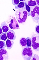 <p>The arrow is pointing to which type of cell in this CSF specimen?</p><p>Macrophage</p><p>Neutrophil</p><p>Lymphocyte</p><p>Malignant cell</p>