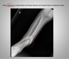 <p>Malunion</p>
