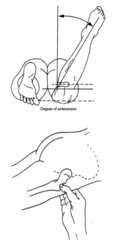 <p>Bilateral, asymmetry is a red flag!!</p><p>Check hip motion while prone:</p><p>- IR usually > 70º (nl 20º-60º)</p><p>- ER usually < 20º (nl 30º-60º)</p><p>Craig's test: assessing trochanteric prominence. >15º is anteversion.</p>